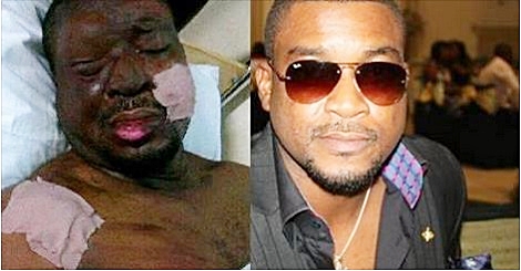 Chidi Mokeme&#39;s Face is Burnt in Hospital Photos - chidi-mokeme-1