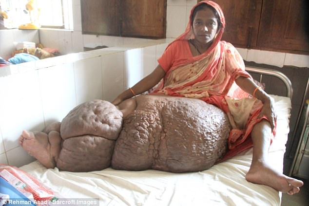 Woman with a breast enlarged by elephantiasis - Stock Image - M160