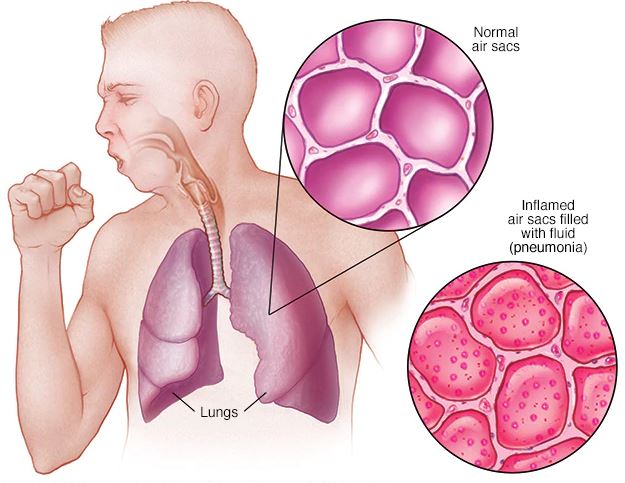 pneumonia