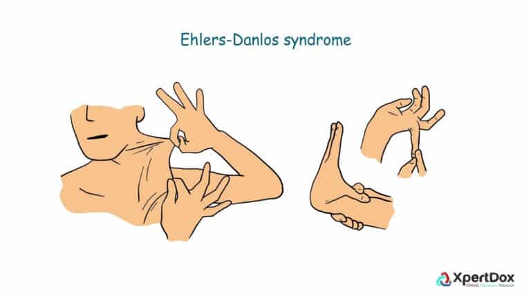 Ehlers–Danlos syndromes