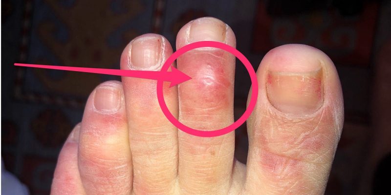 Blistered toe could be a symptom of coronavirus