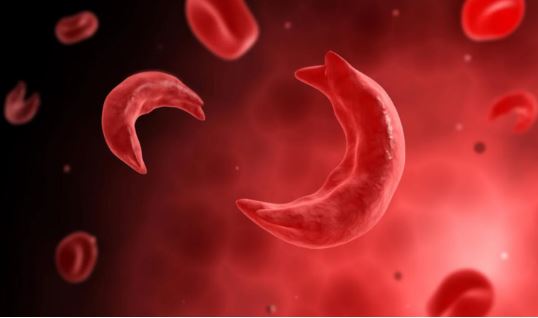 Sickle cell 